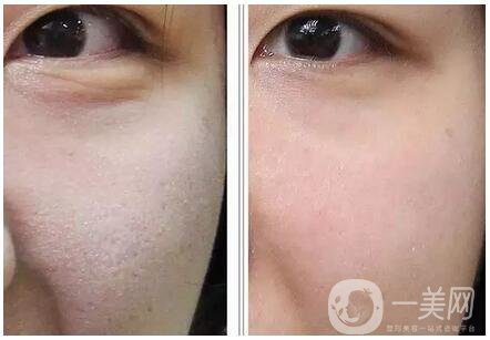 玻尿酸去魚尾紋價格 去魚尾紋費用多少錢