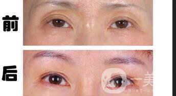 雙眼皮失敗修復,雙眼皮失敗修復多少錢
