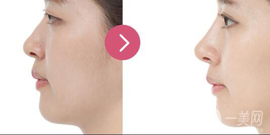 廣東自體脂肪隆鼻價格,自體脂肪隆鼻注意事項