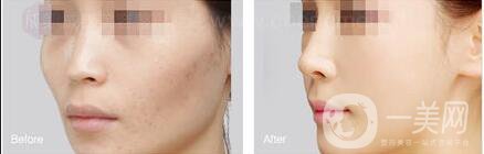 上海自體脂肪填充面部多少錢,自體脂肪填充面部注意事項