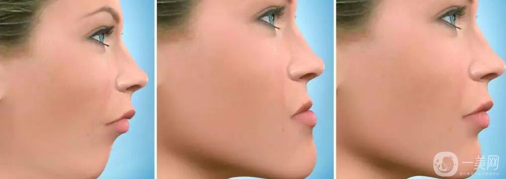 深圳天包地矯正多少錢,天包地矯正術(shù)后護理