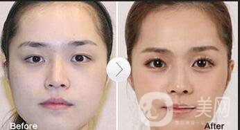 上海*臥蠶手術多少錢,*臥蠶手術注意事項