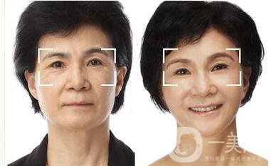 熱瑪吉緊膚除皺,熱瑪吉緊膚除皺注意事項