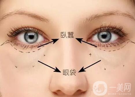 臥蠶整形,深圳臥蠶整形價格