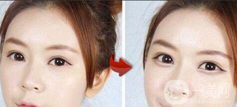 臥蠶整形,深圳臥蠶整形價格