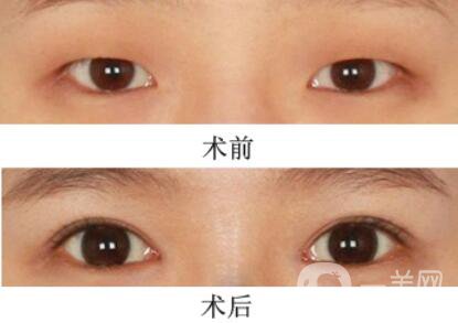 三點定位割雙眼皮多久恢復