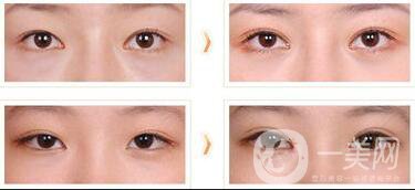 三點定位割雙眼皮多久恢復