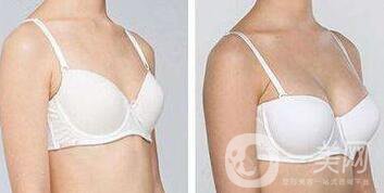 假體豐胸需要恢復(fù)多久