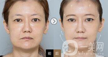 拉皮手術(shù)后遺癥