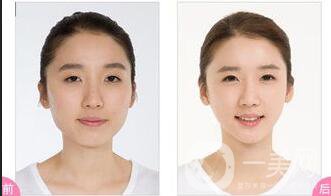 雙下巴吸脂,雙下巴吸脂多少錢,北京雙下巴吸脂多少錢