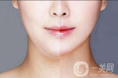 光纖溶脂雙下巴,光纖溶脂雙下巴價格,上海光纖溶脂雙下巴價格