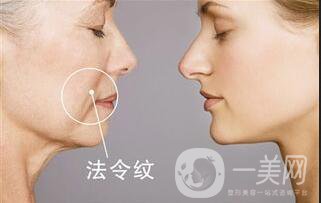 北京*去法令紋多少錢(qián),*去法令紋多少錢(qián),*去法令紋