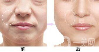 北京*去法令紋多少錢(qián),*去法令紋多少錢(qián),*去法令紋