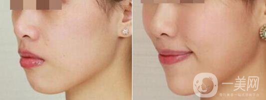 深圳打蘋果肌多少錢,豐蘋果肌