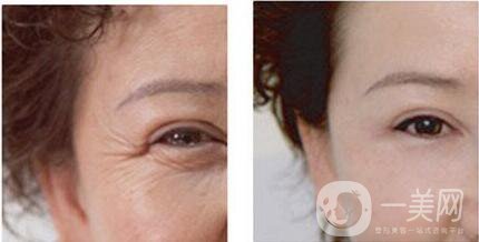 上海魚尾紋除皺多少錢,魚尾紋除皺