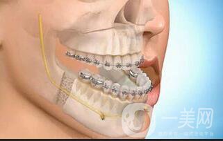深圳牙齒地包天矯正價(jià)格,地包天矯正
