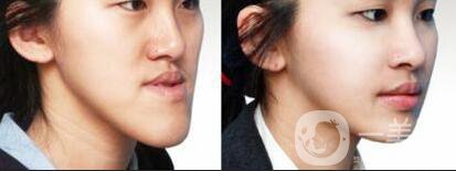 深圳牙齒地包天矯正價(jià)格,地包天矯正