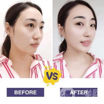 溶脂減肥的危害主要有哪些？詳細(xì)介紹