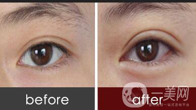 廣東自體脂肪豐臥蠶多少錢,自體脂肪豐臥蠶多少錢,自體脂肪豐臥蠶