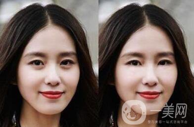 自體脂肪豐臥蠶術(shù)后護(hù)理主要有些什么注意事項(xiàng)