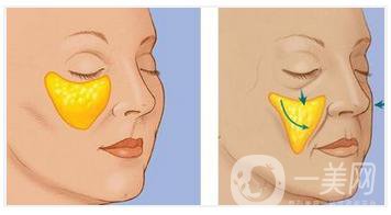 上海自體脂肪豐蘋果肌手術(shù)做一次多少錢