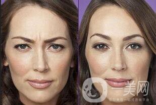 自體脂肪去眉間紋*果,自體脂肪去眉間紋注意事項(xiàng)