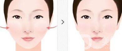 顴骨內(nèi)推*果維持時間,顴骨內(nèi)推術(shù)后護(hù)理方式