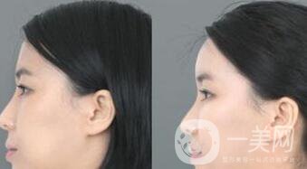 北京自體脂肪豐額頭價格