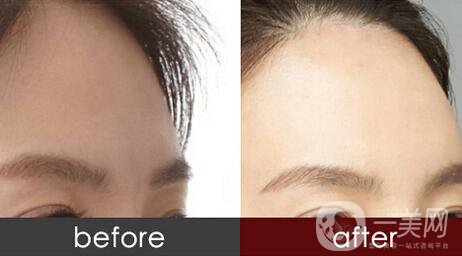 深圳額頭注射玻尿酸多少錢,額頭注射玻尿酸多少錢,額頭注射玻尿酸