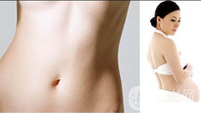 去妊娠紋方法
