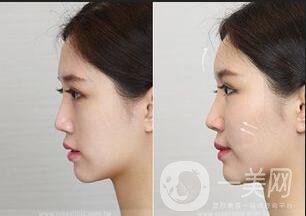 廣東注射玻尿酸豐蘋果肌多少錢,注射玻尿酸豐蘋果肌多少錢