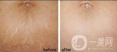 去妊娠紋注意事項