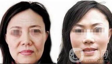 熱瑪吉緊膚除皺術后護理