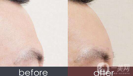 北京額頭打玻尿酸多少錢,額頭打玻尿酸多少錢