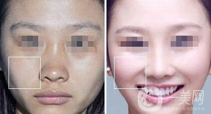 上海注射豐蘋果肌多少錢,注射豐蘋果肌多少錢,注射豐蘋果肌