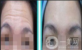 北京自體脂肪去抬頭紋價(jià)格