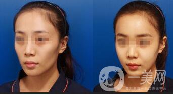 深圳臉部自體脂肪填充價(jià)格