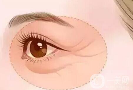 眼周年輕化手術(shù)注意事項(xiàng)