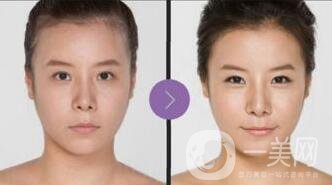 廣東自體脂肪豐面頰價格