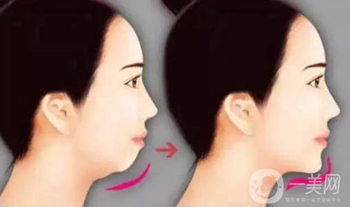 膨體墊下巴有沒(méi)有后遺癥？有些什么后遺癥