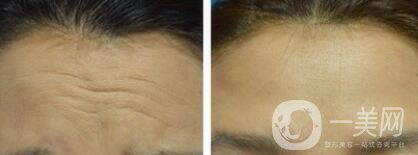 上海*去抬頭紋多少錢