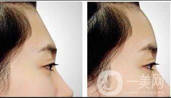 上海額頭自體填充價(jià)格