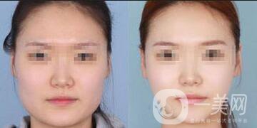 深圳去頰脂墊瘦臉價格