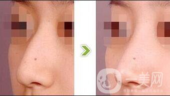 深圳鷹鉤鼻修復(fù),深圳鷹鉤鼻修復(fù)多少錢