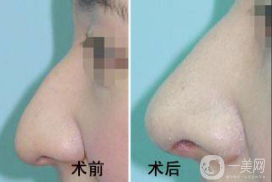 廣東鷹鉤鼻手術(shù)多少錢,鷹鉤鼻手術(shù)多少錢