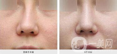廣東歪鼻矯正手術(shù)費用,歪鼻矯正手術(shù)費用,歪鼻矯正手術(shù)