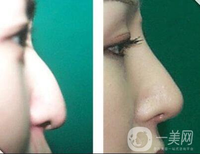 廣東駝峰鼻矯正費(fèi)用,駝峰鼻矯正費(fèi)用