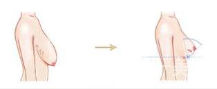 上?？s乳手術(shù)多少錢,縮乳手術(shù)多少錢