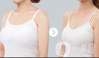 上?？s乳手術(shù)多少錢,縮乳手術(shù)多少錢