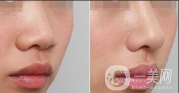 北京軟骨隆鼻手術(shù)多少錢(qián)